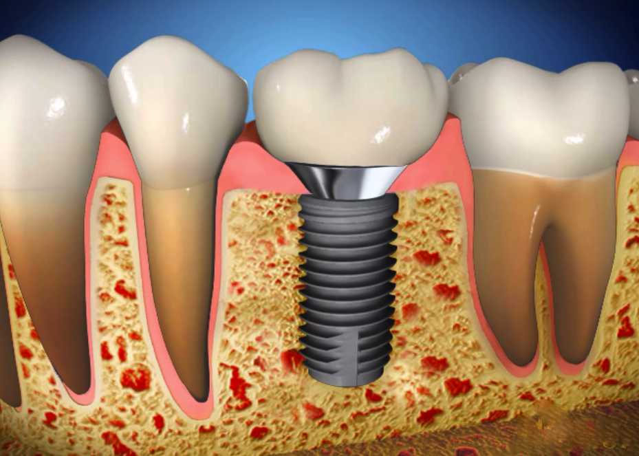 les Implants dentaires