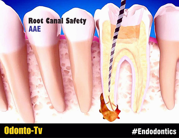 ENDODONTICS Root Canal Safety American Association of Endodontists
