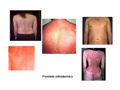 Psoriasis eritrodermica