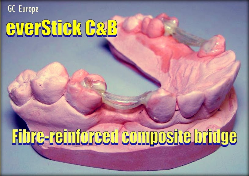 DENTAL MATERIALS Fibrereinforced composite bridge with everStick C&B