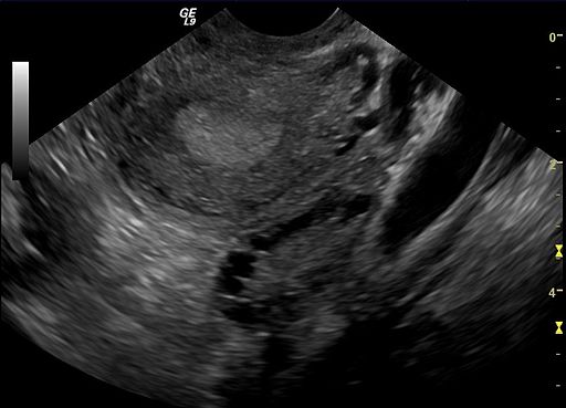 Ultrasound Imaging of a Polycystic ovary