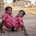 Indian Conjoined Twins Say ‘We Don’t Wish To Get Separated’