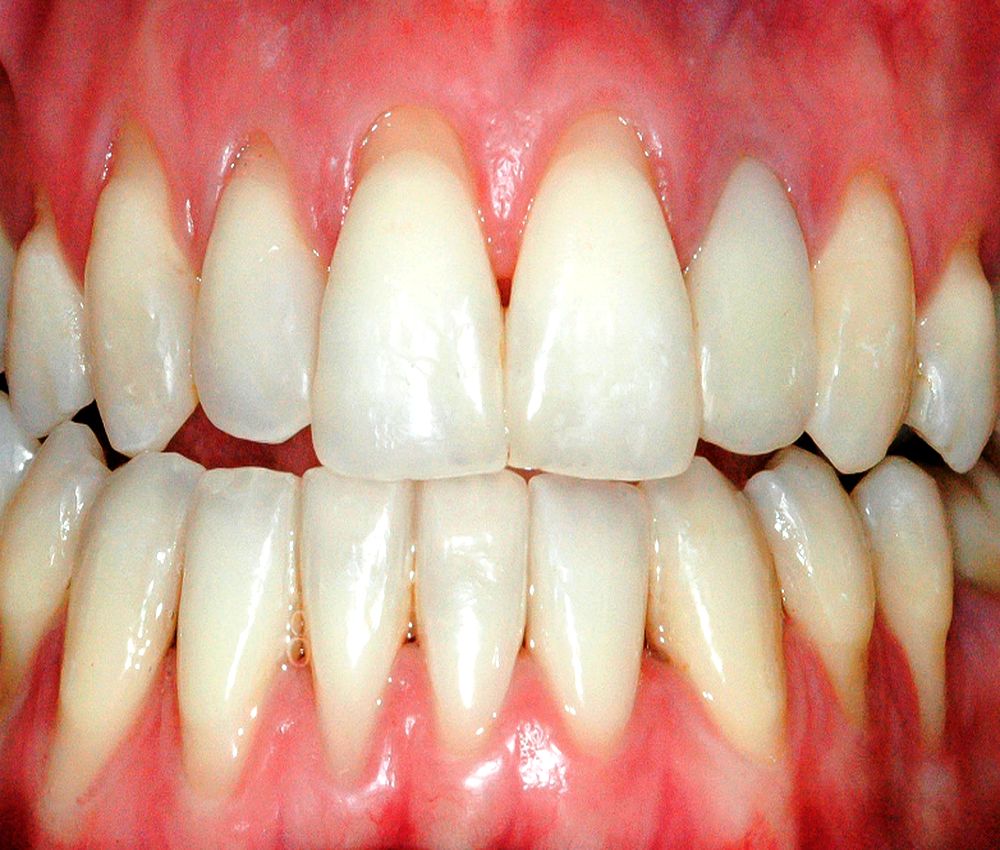 gingival-recession