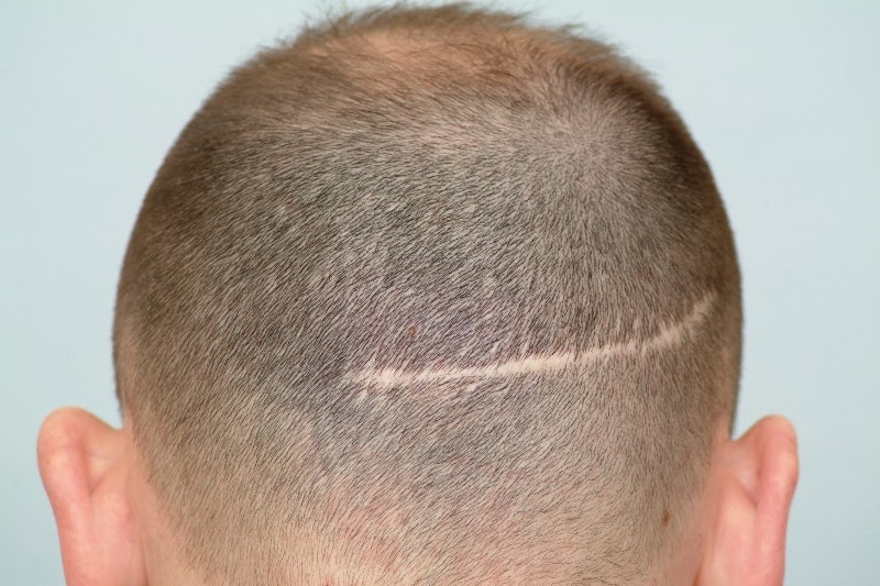 Your Hair Transplant Scars Can Be Corrected