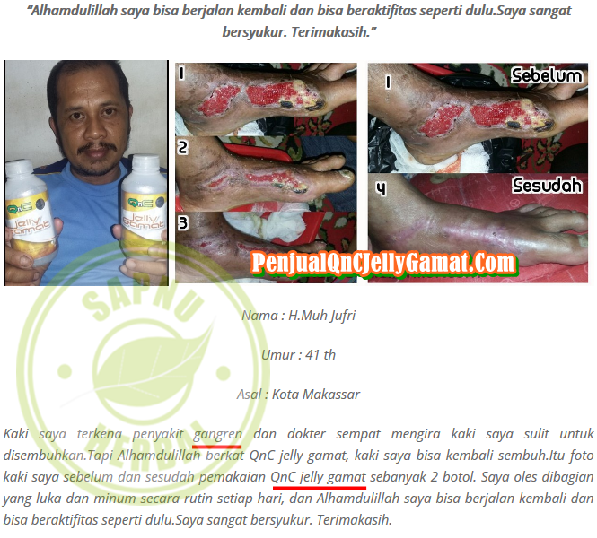 Cara Menyembuhkan Luka Borok di Kaki Secara Alami Sampai Tuntas ~ Testimoni QNC JELLY GAMAT Cara Menyembuhkan Luka Borok di Kaki Secara Alami Sampai Tuntas ~ Testimoni QNC JELLY GAMAT