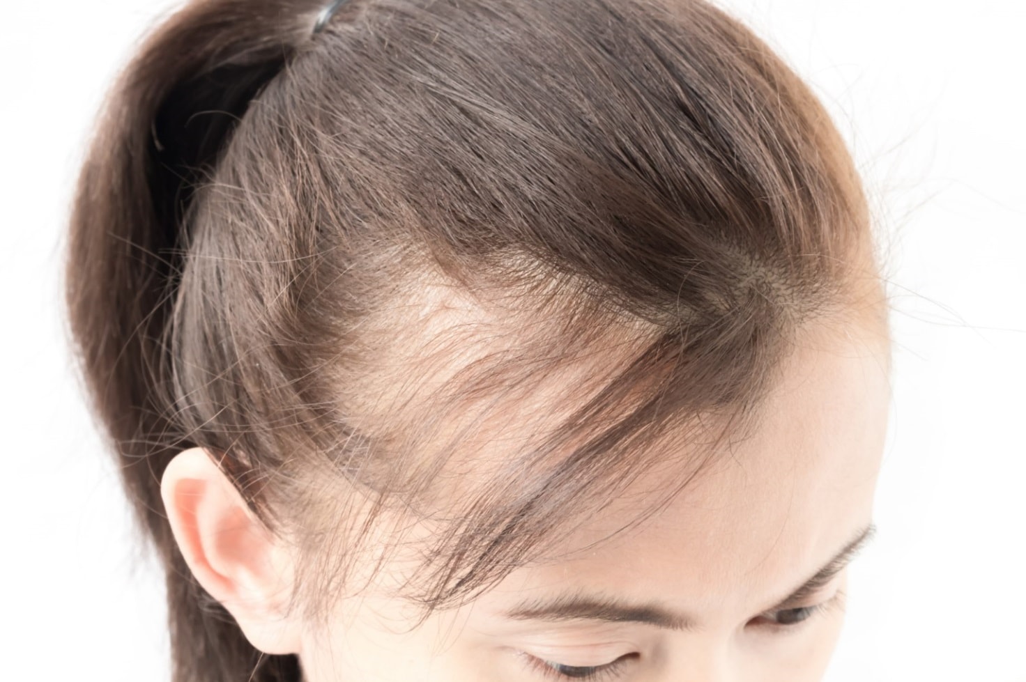La Perte de Cheveux chez les Femmes