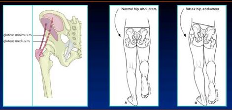 waddling gait / myopathic gait / gait training / myopathic gait treatment / waddling  gait treatment - PHYSIO STUDY