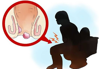 Jual Obat wasir di Kota Raha, tumbuhan alami obat wasir, penyakit ambeien atau wasir harus ke dokter apa, obat dokter untuk ambeien berdarah, nama obat wasir untuk ibu hamil, hubungan penyakit ambeyen dengan cairan tubuh, obat herbal ambeien atau wasir atau ambien, pengobatan ambeien jambi, obat wasir ampuh apotik, cara mengatasi wasir untuk ibu hamil, cara mengobati ambeien atau wasir atau wasir secara alami, pengobatan alternatif wasir atau ambeien di bekasi, gambar benjolan ambeien, Jual Obat wasir di Pulau Morotai, perbedaan penyakit wasir dan varises, mengobati wasir ambeien, obat ampuh ambeien dalam, ambeien muncul benjolan, cara menyembuhkan ambeien atau wasir dengan jeruk nipis, Jual Obat wasir di Paringin, gejala penyakit ambeien atau wasir dalam, cara mengobati wasir atau ambeien dgn obat tradisional, cara alami menyembuhkan wasir berdarah, cara mengobati ambeien yg alami, mengatasi ambeien atau wasir setelah melahirkan