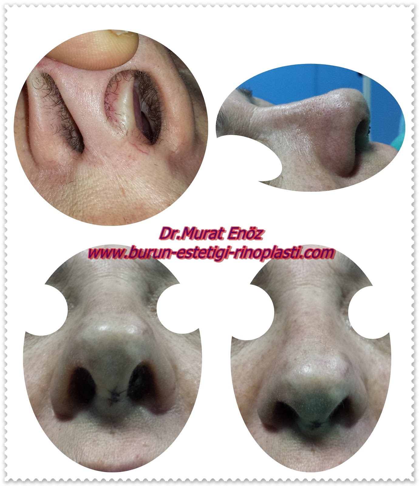 Septoplasty Technique