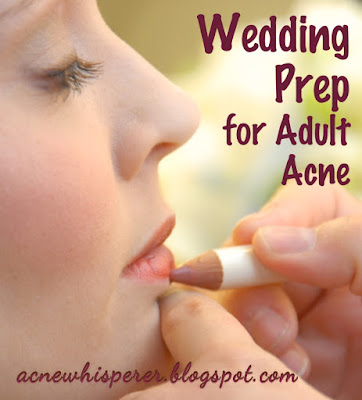Wedding prep for adult acne