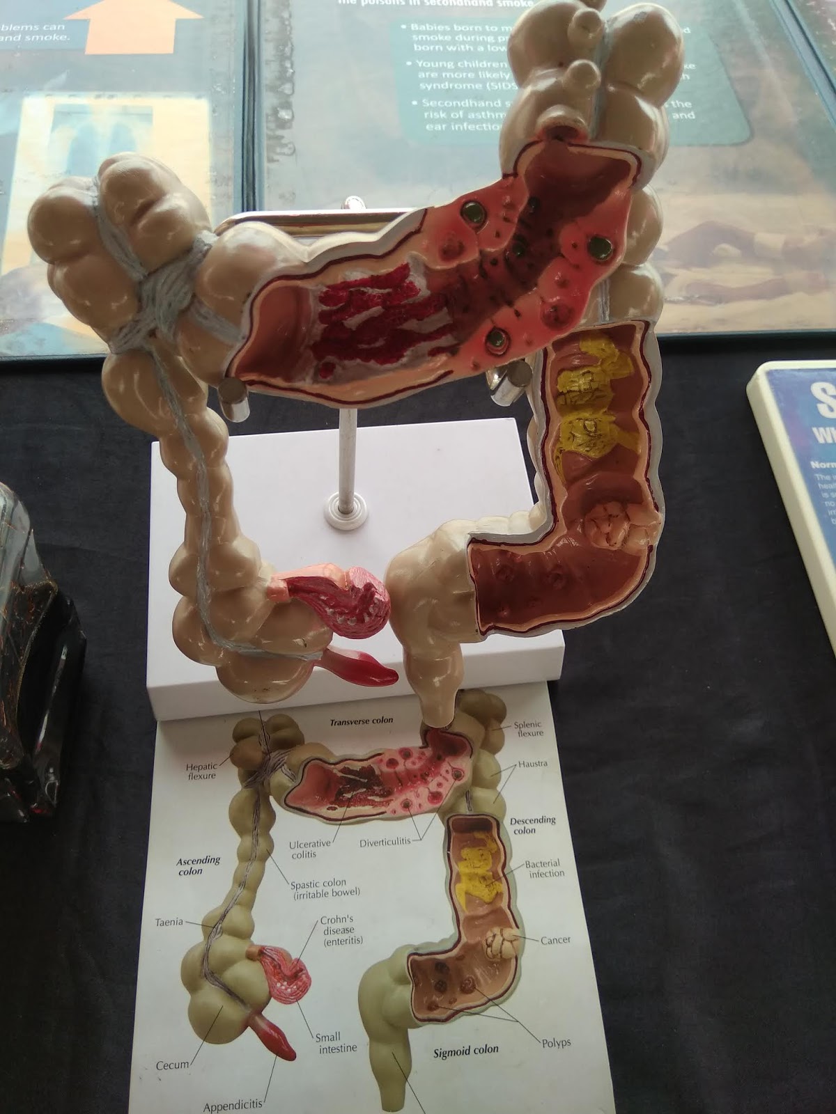 Coretan Ida Kamilia Mudzakir: MAKNA | Program Saringan Bergerak Kanser