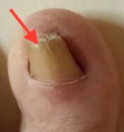 Verdickte Zehennägel Fußnagelpilz 