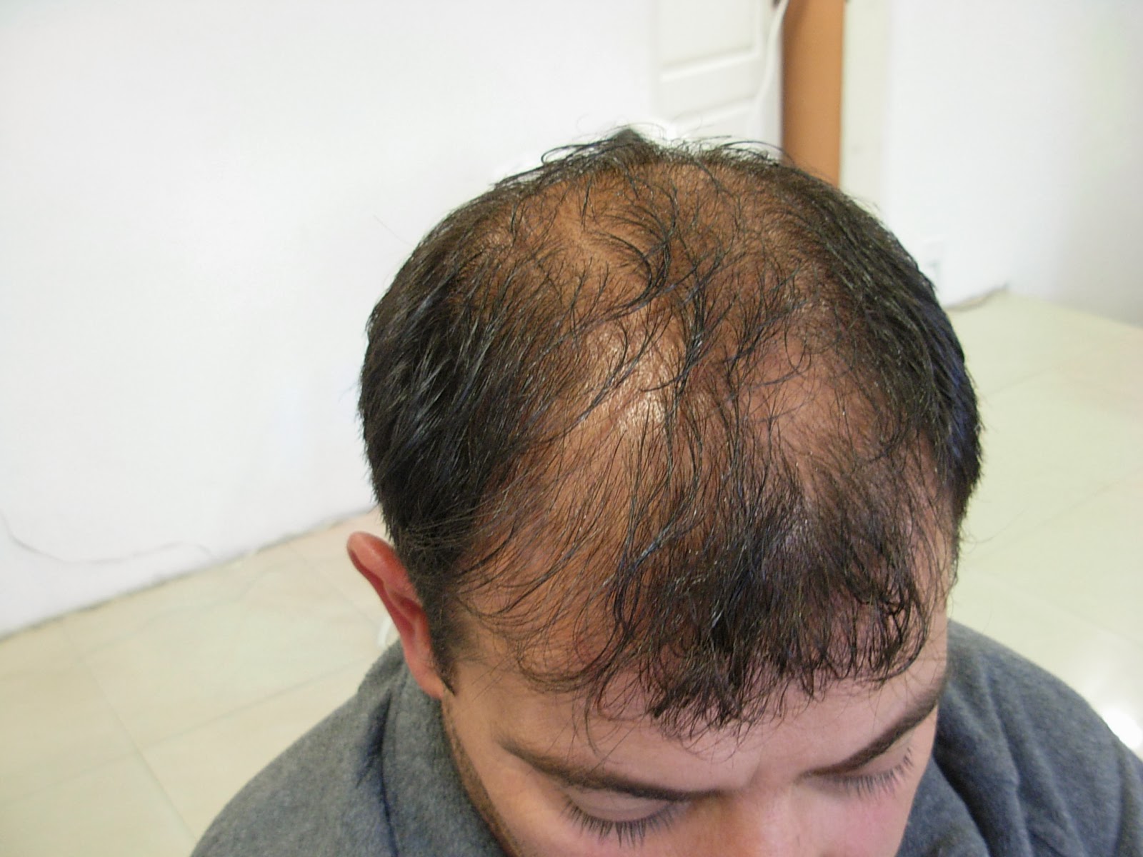 Recuperacion Capilar Medical Hairs Ap Casos exitosos