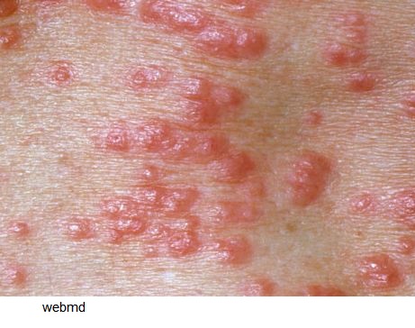 scabies rash spot health