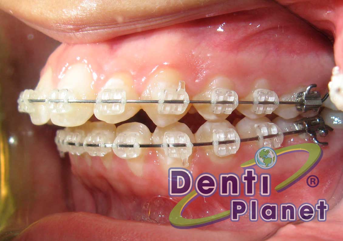 Blog Ortodoncia abril 2011