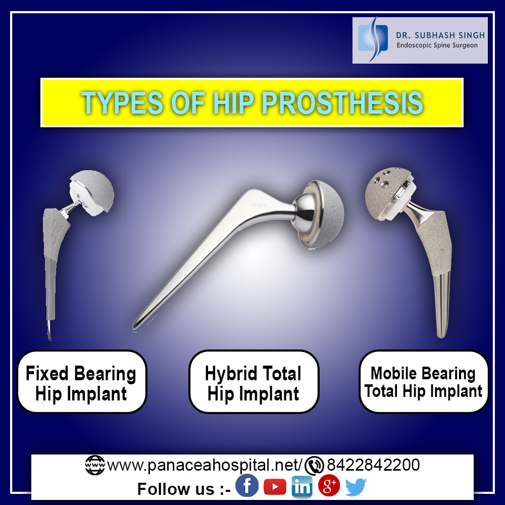 Types Of Hip Prosthesis