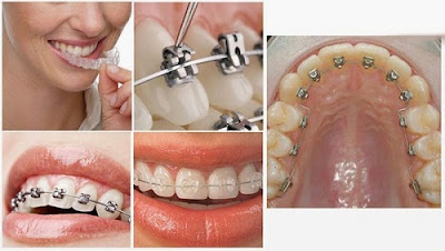  Niềng răng có ảnh hưởng đến sức khoẻ không?