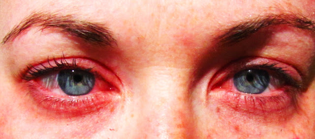 Eye Allergy Season at Evolutionary Eye Care in Sugar Land, Greatwood & Richmond Area