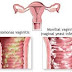 Apa itu infeksi jamur vagina? (Vaginal Yeast Infection)