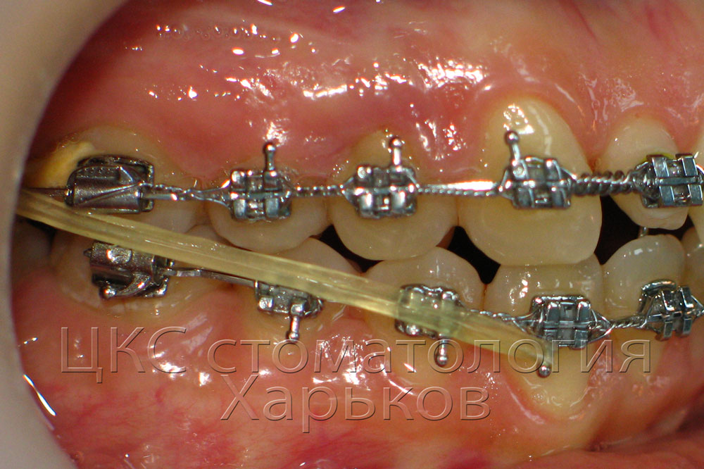 О стоматологии и не только...: Ортодонтические эластики. Эластики для ...