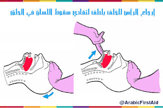 تقنيات (الإسعافات الإولية و الطوارئ) Liberation%2Bdes%2Bvoiex%2Baeriene%2Bbasculer%2Bla%2Btete%2Ben%2Barriere%2Bcontre%2Bchute%2Bde%2Blongue