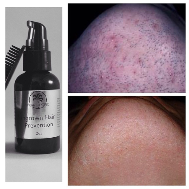 PureTropix Ingrown hair treatment