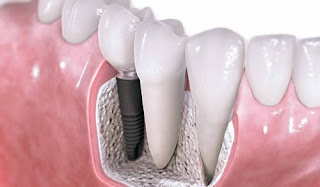 Có nên trồng răng để phục hình răng mất không?