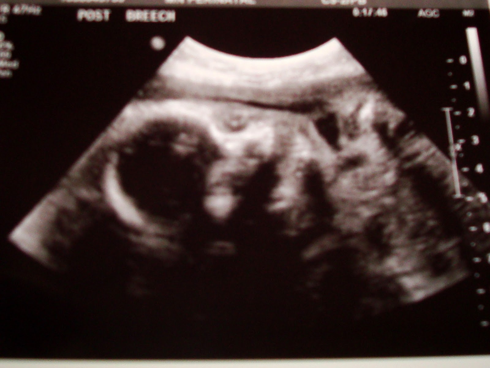 Real Life: A MN Mom: 25 weeks pregnant update...