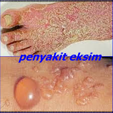Image Gatal Gatal di Selangkangan