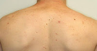 Cara Mengatasi Jerawat Dengan Bahan Alami Cara Mengatasi Jerawat Dengan Bahan Alami