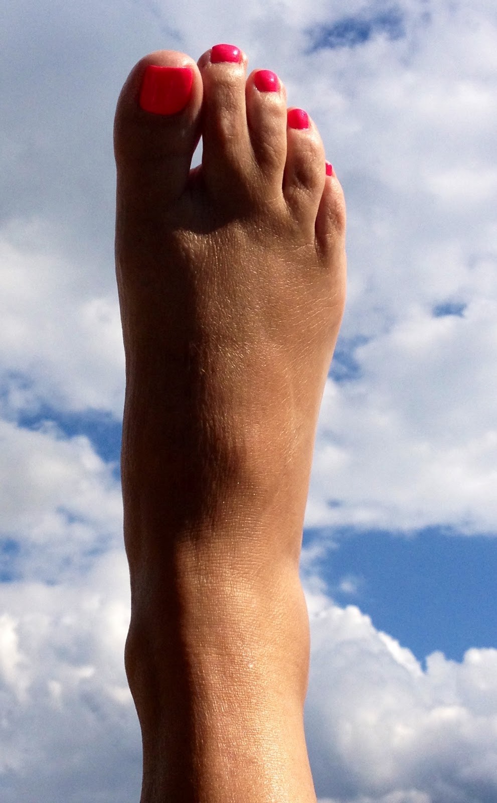 After LisFranc Surgery Weekly Lisfranc Surgery images during recovery