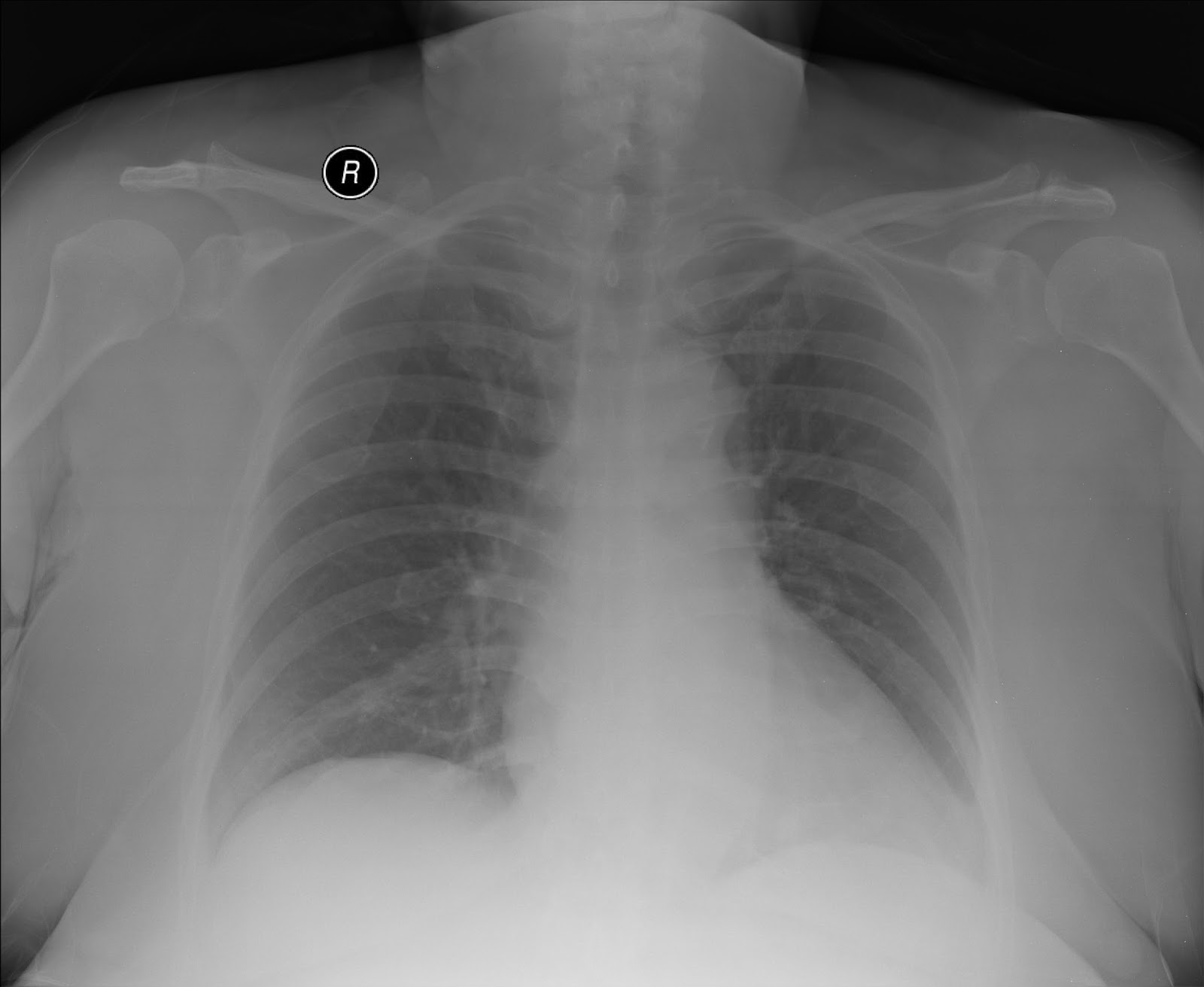 chest xray normal vs abnormal chest xray normal vs abnormal