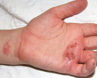 eczema causes