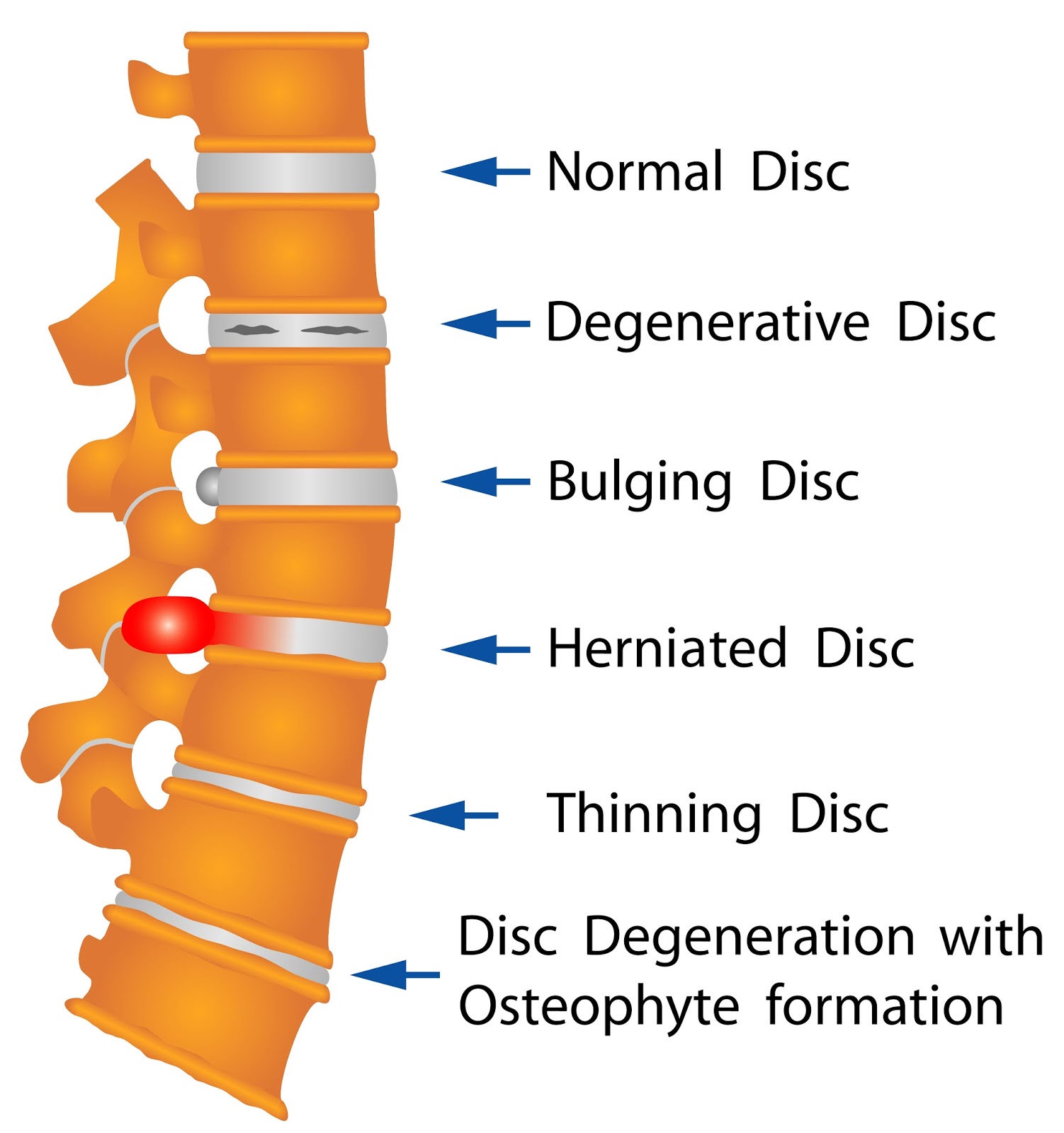 Degenerative Disc Disease, Symptoms & Exercises Optimum Rehab