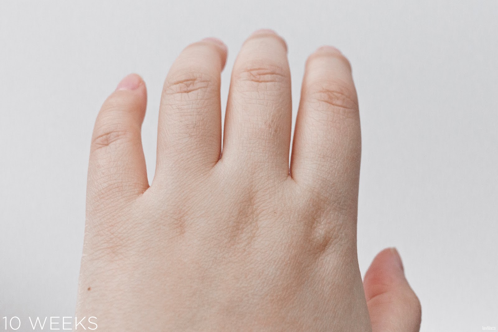 tria Hair Removal Laser Knuckle Hair 10 Weeks, 2 months