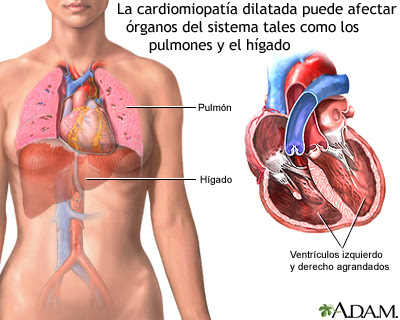 La cardiomiopatía