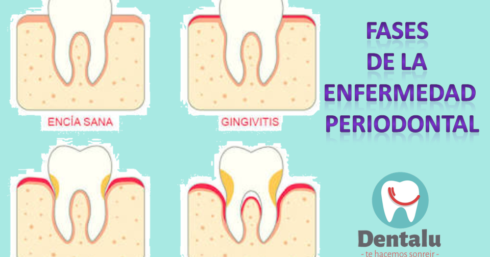 DENTALU GINGIVITIS Y ENFERMEDAD PERIODONTAL