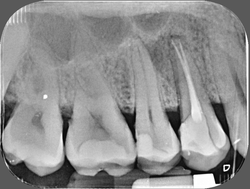 LA CATEDRA DE LA ENDODONCIA : Caso clinico diente fisurado