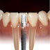 Os benefícios do implante dentário