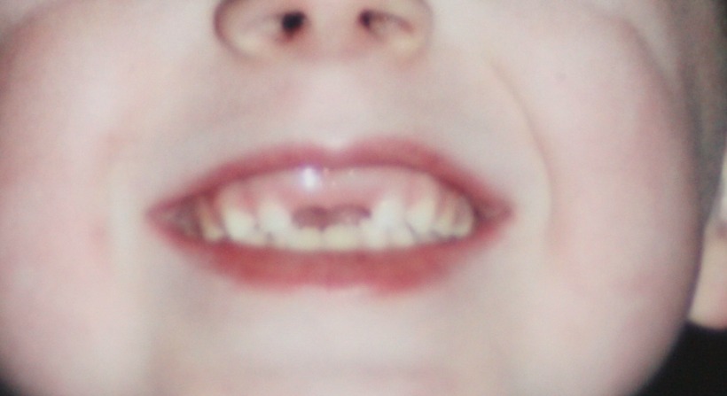 Gappy teeth - Mum of Three World