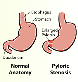 hypertrophic pyloric stenosis