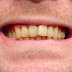 Giải quyết răng nhiễm màu tetracyclin cho răng trắng sáng