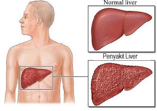 Jangan Anggap Remeh Penyakit Liver, Kenali Gejala Penyakit ini Sebelum Parah