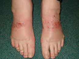 Latex allergy croc shoes Latex allergy croc shoes