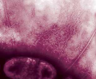 Enterodherant Escherichia coli (EAEC) Enterodherant Escherichia coli (EAEC)