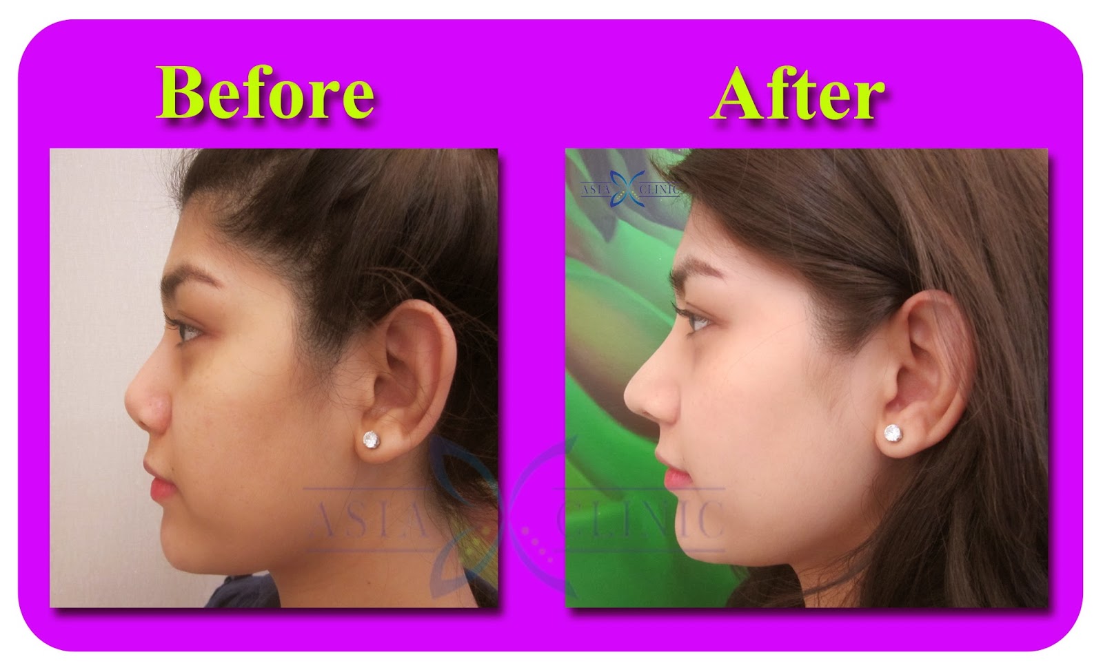 Rhinoplasty Surgery Thailand: Nose Augmentation Before And After Photos