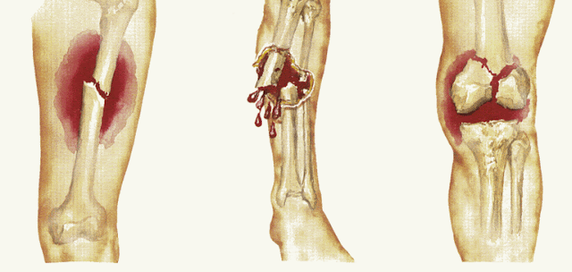 open vs closed fracture open vs closed fracture