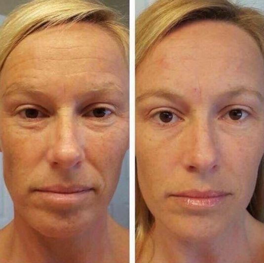 Facial exercise to get rid of frown lines