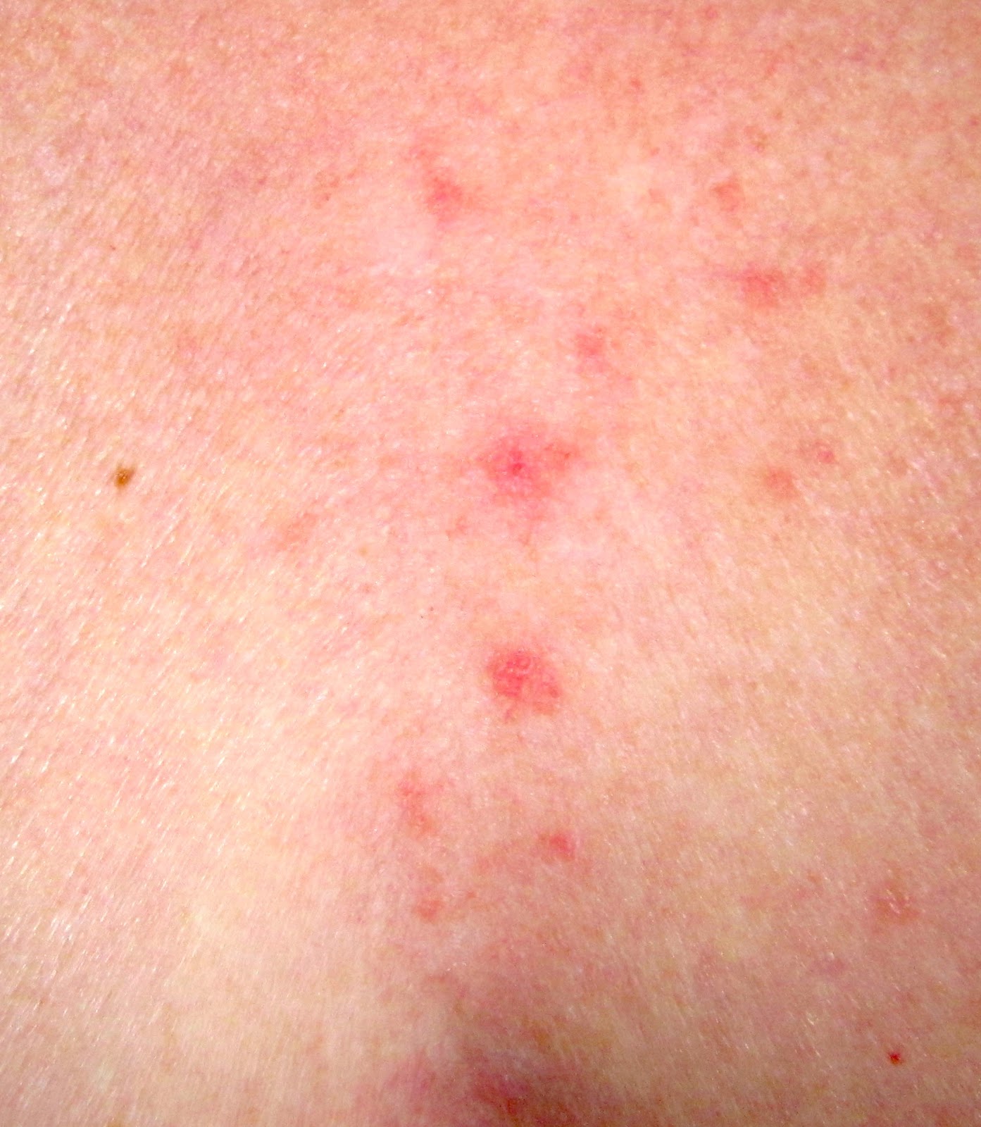 Skin Cancer Itchy Rash