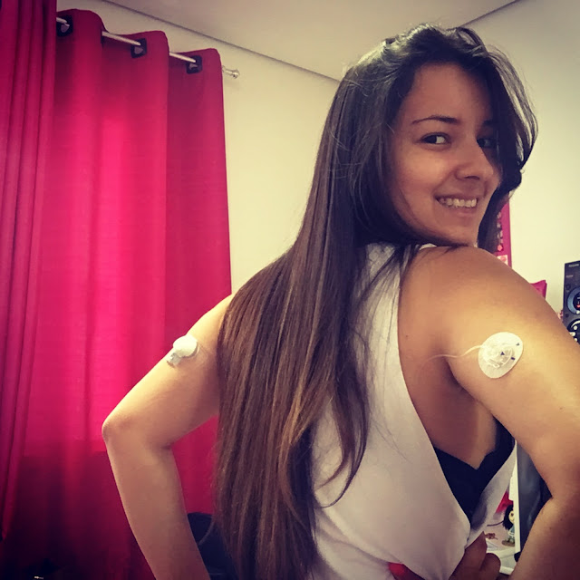 bomba de insulina e sensor enlite no braço